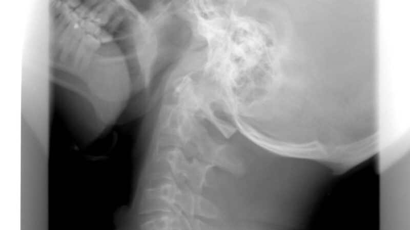 Czy pilates pomaga na problemy z kręgosłupem?